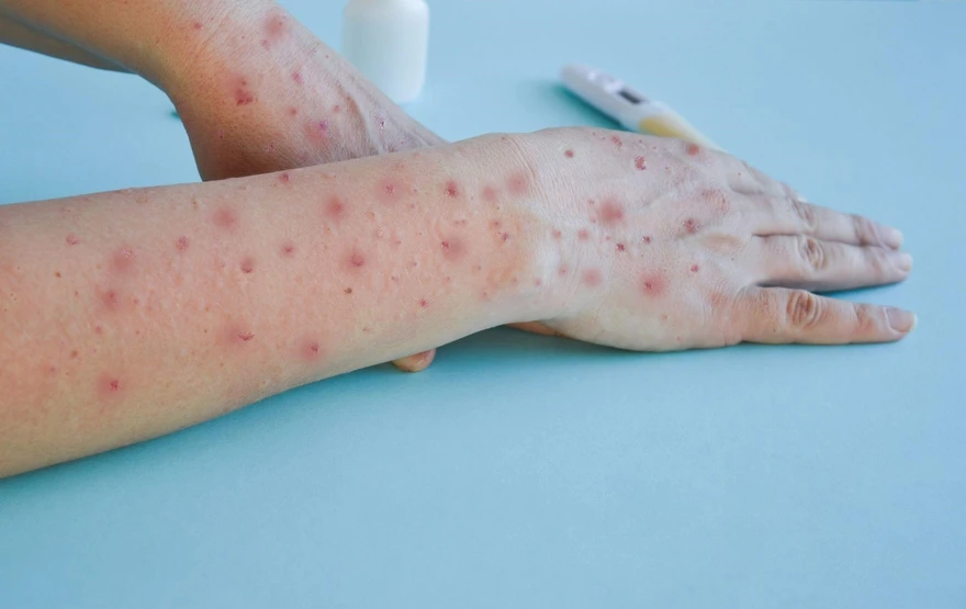 Mpox Symptoms